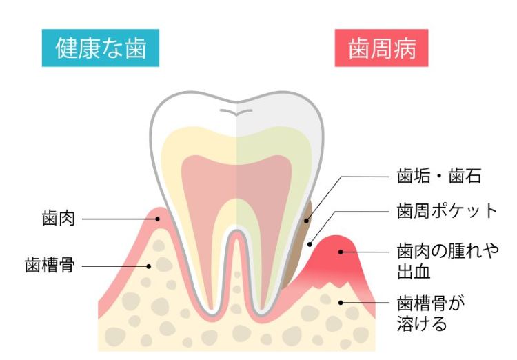 健康な歯と歯槽膿漏・歯周病の図
